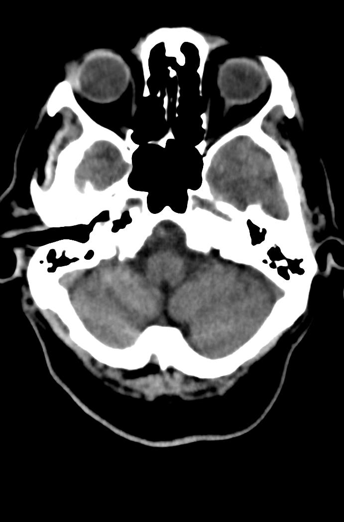 Artery of Percheron infarction (Radiopaedia 80613-94202 Axial non-contrast 45).jpg