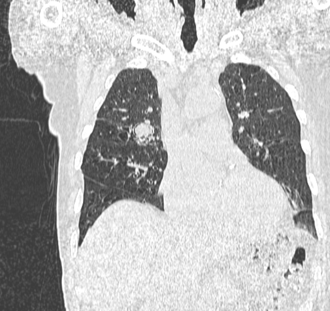 Aspergilloma (Radiopaedia 44592-48327 Coronal lung window 45).jpg