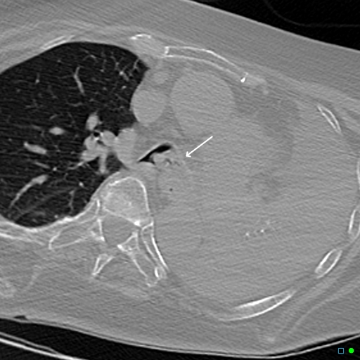 File:Aspirated food bolus obstruction of left main bronchus (Radiopaedia 29432-29904 Axial non-contrast 11).jpg