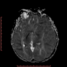 Astroblastoma (Radiopaedia 74287-85162 Axial ADC 29).jpg
