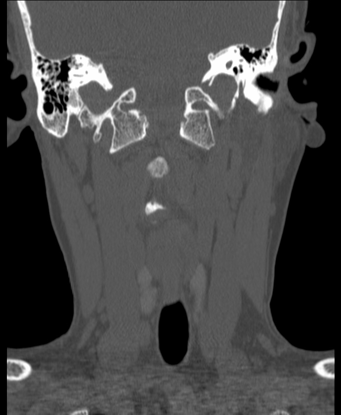 Atlanto-occipital assimilation with basilar invagination (Radiopaedia 70122-80188 Coronal bone window 62).jpg