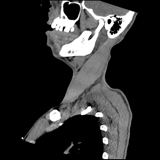 File:Atlanto-occipital dissociation (Traynelis type 1), C2 teardrop fracture, C6-7 facet joint dislocation (Radiopaedia 87655-104061 D 19).jpg
