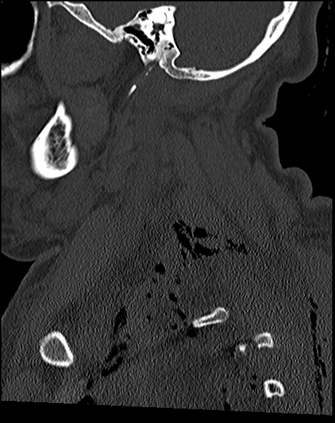 Atlanto-occipital dissociation - Traynelis type 1 (Radiopaedia 87570-103948 Sagittal bone window 26).jpg