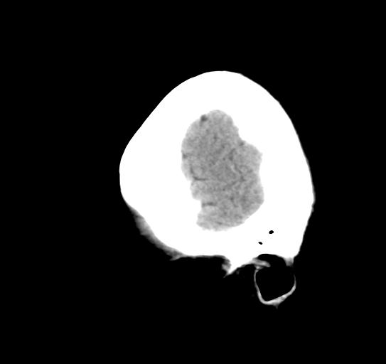 File:Atretic encephalocoele with inferior vermis hypoplasia (Radiopaedia 30443-31107 C 27).jpg