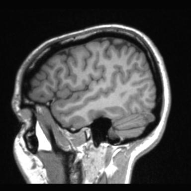 Atretic encephalocoele with inferior vermis hypoplasia (Radiopaedia 30443-31108 Sagittal T1 109).jpg