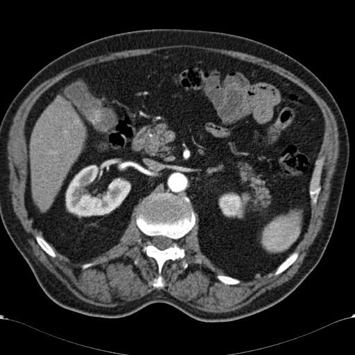Atypical hepatocellular carcinoma (Radiopaedia 41744-44698 A 41).jpg