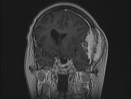 Atypical meningioma (Radiopaedia 62985-71406 Coronal T1 C+ 42).jpg