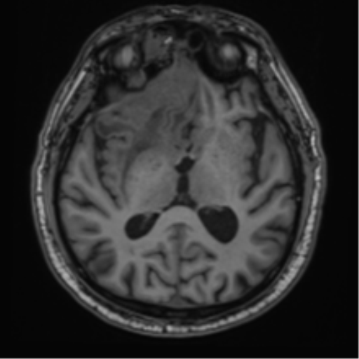 File:Atypical meningioma (WHO grade II) with brain invasion (Radiopaedia 57767-64729 Axial T1 25).png