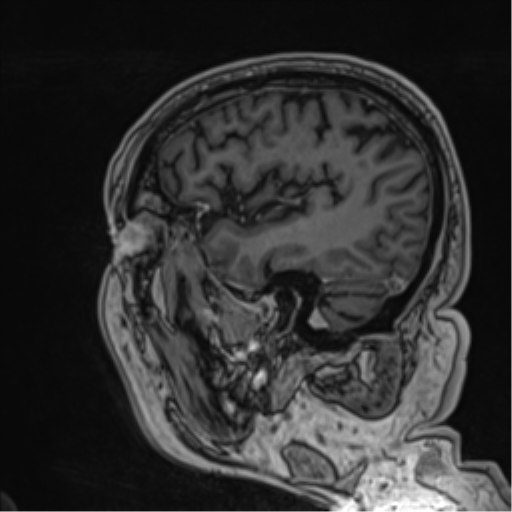Atypical meningioma (WHO grade II) with brain invasion (Radiopaedia 57767-64729 Sagittal T1 C+ 21).png