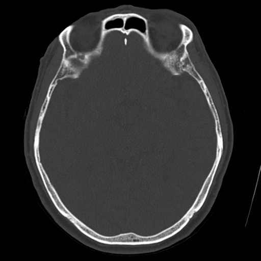 Atypical meningioma (WHO grade II) with osseous invasion (Radiopaedia 53654-59715 Axial bone window 37).png