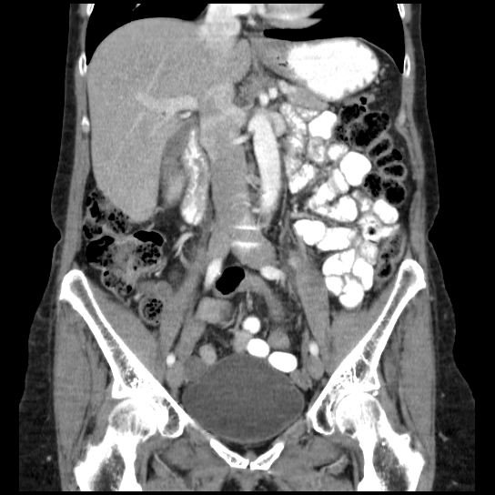 File:Atypical renal cyst (Radiopaedia 17536-17251 C 21).jpg