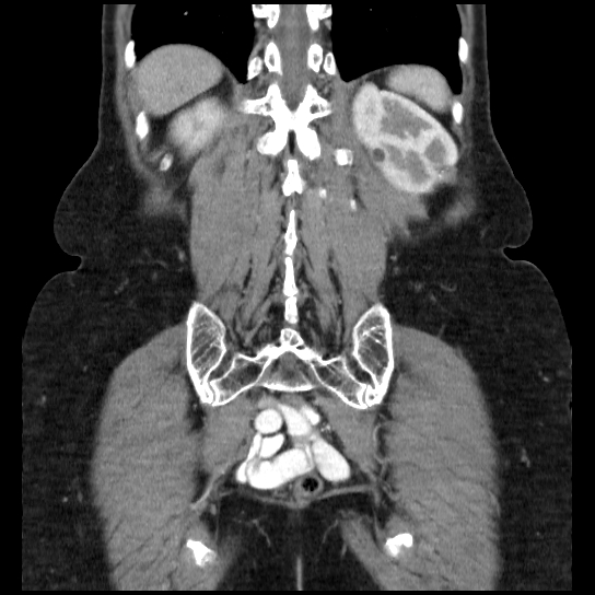 File:Atypical renal cyst (Radiopaedia 17536-17251 C 6).jpg