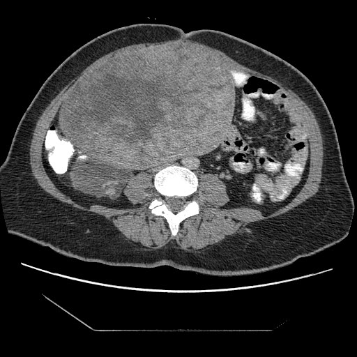 File:Atypical retroperitoneal lymphocoeles with large leiomyoma of uterus (Radiopaedia 32084-33024 A 23).jpg