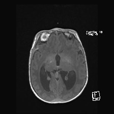 Atypical teratoid rhabdoid tumor (prenatal US and neonatal MRI) (Radiopaedia 59091-66388 Axial T1 29).jpg