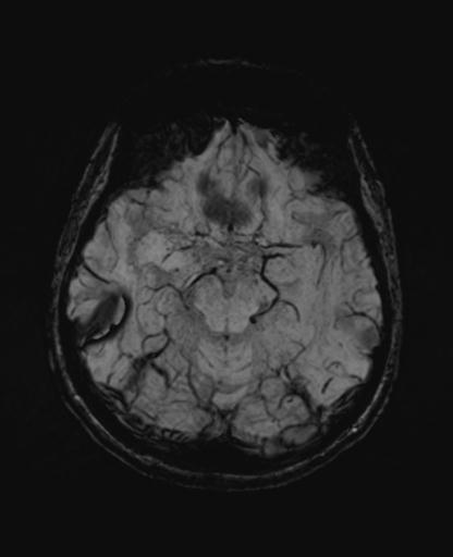 Autoimmune limbic encephalitis (Radiopaedia 30363-31005 SWI - mIP 27).jpg