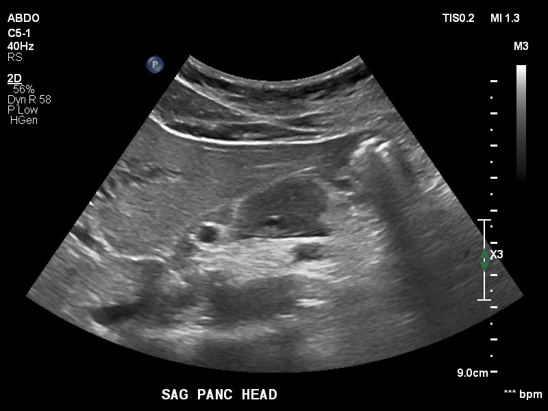 File:Autoimmune pancreatitis (Radiopaedia 88443-105100 C 4).jpg