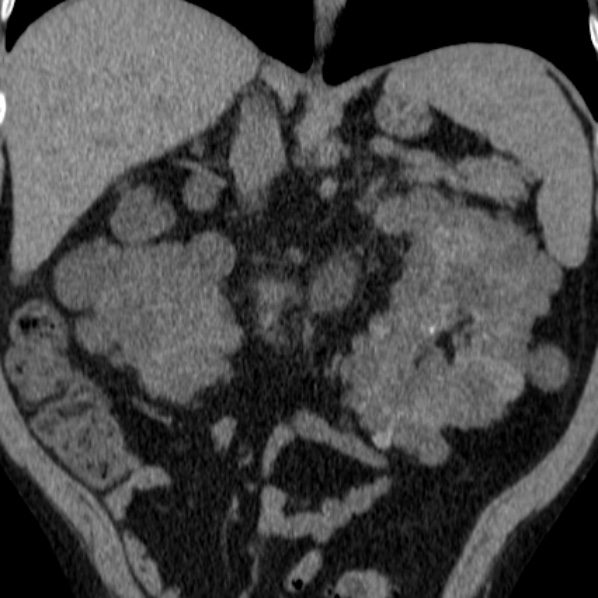 File:Autosomal dominant polycystic kidney disease (Radiopaedia 36539-38101 Coronal non-contrast 20).jpg