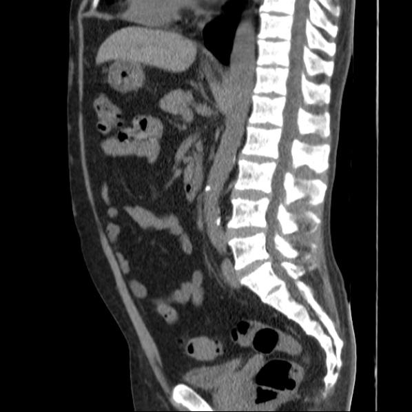 Autosomal dominant polycystic kidney disease (Radiopaedia 36539-38101 D 45).jpg