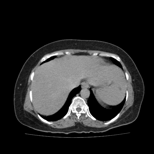 Autosomal dominant polycystic kidney disease (Radiopaedia 38189-40194 Axial C+ delayed 3).jpg