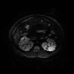 Autosomal dominant polycystic kidney disease (Radiopaedia 50259-55611 Axial DWI 57).jpg