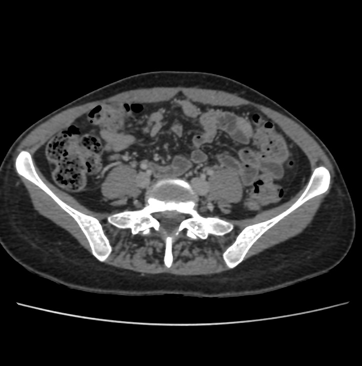 Autosomal dominant polycystic kidney disease - early onset (Radiopaedia 40734-43387 A 59).jpg
