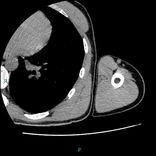 File:Avascular necrosis after fracture dislocations of the proximal humerus (Radiopaedia 88078-104655 D 112).jpg