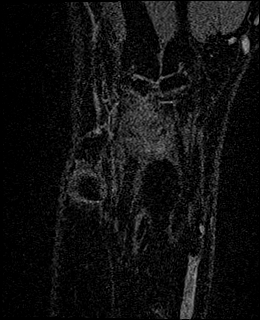 Avascular necrosis of the capitate (Radiopaedia 88317-104948 Coronal T1 vibe 12).jpg