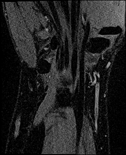 Avascular necrosis of the capitate (Radiopaedia 88317-104948 Coronal T1 vibe 63).jpg
