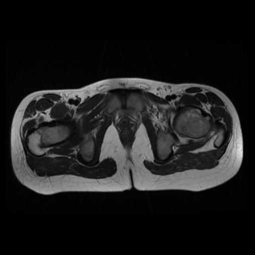 File:Avascular necrosis of the hip (Radiopaedia 29563-30067 Axial T2 12).jpg