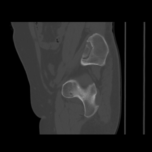 Avascular necrosis of the hip (Radiopaedia 61503-69467 B 41).jpg