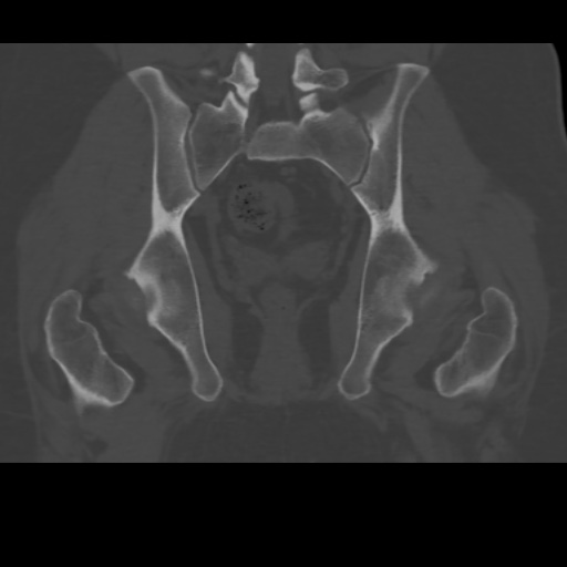 File:Avascular necrosis of the hip (Radiopaedia 61503-69467 Coronal bone window 25).jpg