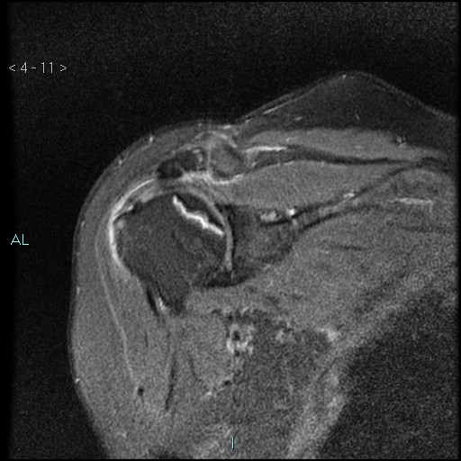 File:Avascular necrosis of the shoulder - Cruess stage I (Radiopaedia 77674-89886 Coronal PD fat sat 11).jpg