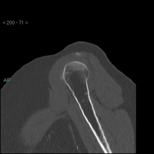 Avascular necrosis of the shoulder - Cruess stage I (Radiopaedia 77674-89887 Sagittal bone window 70).jpg