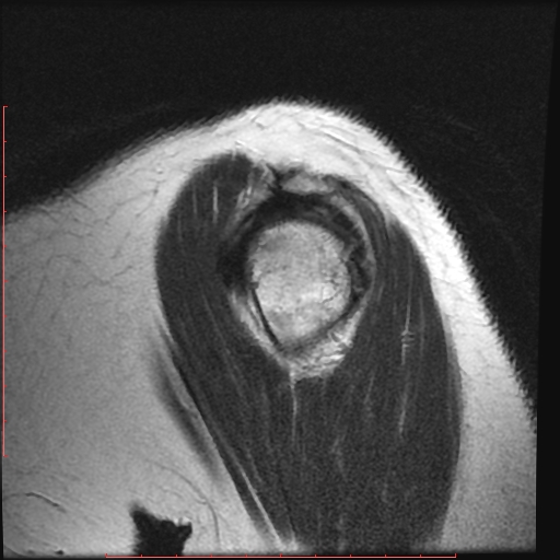 File:Avulsion fracture - greater tuberosity of humerus (Radiopaedia 25457-25703 Sagittal T2 9).jpg