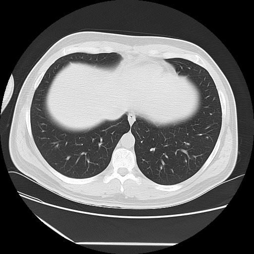 Azygos fissure (Radiopaedia 88181-104784 Axial lung window 42).jpg