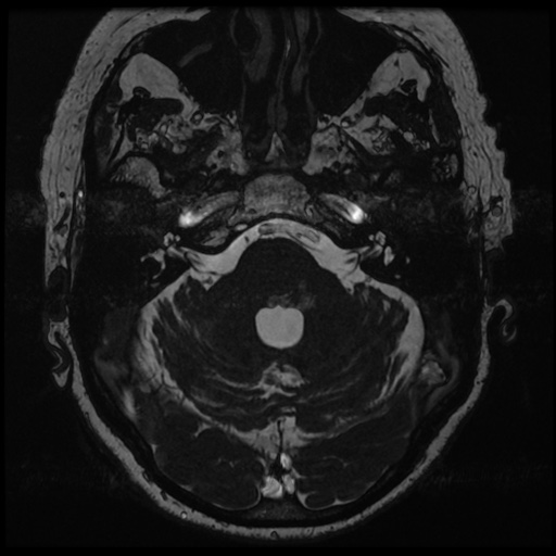 File:Balo concentric sclerosis (Radiopaedia 53875-59982 Axial T2 FIESTA 36).jpg