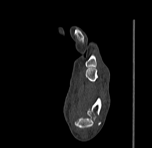 Base of 2nd metacarpal fracture (Radiopaedia 73741-84544 Sagittal bone window 59).jpg