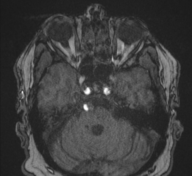 Basilar artery dissection (Radiopaedia 77032-88976 Axial TOF 58).jpg