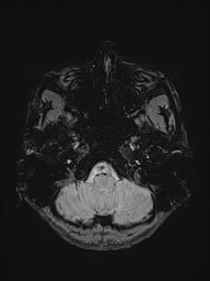 Basilar artery perforator aneurysm (Radiopaedia 82455-97733 Axial SWI 5).jpg
