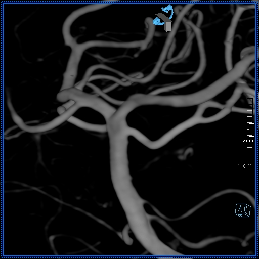 Basilar artery perforator aneurysm (Radiopaedia 82455-99524 3D Left VA 35).jpg