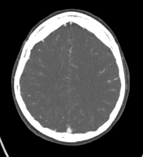 Basilar tip aneurysm with coiling (Radiopaedia 53912-60086 A 108).jpg