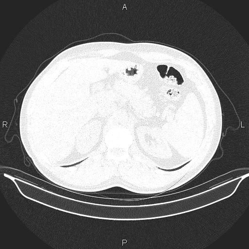 File:Beam hardening and ring artifacts (Radiopaedia 85323-100915 Axial lung window 75).jpg
