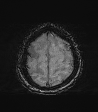 File:Behavioral variant frontotemporal dementia and late onset schizophrenia (Radiopaedia 52197-58083 Axial SWI 68).png