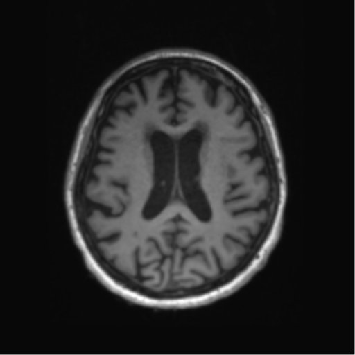 Behavioral variant frontotemporal dementia and late onset schizophrenia (Radiopaedia 52197-58083 Axial T1 37).png