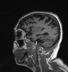 Behavioral variant frontotemporal dementia and late onset schizophrenia (Radiopaedia 52197-58083 Sagittal T1 17).png