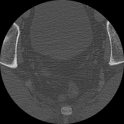 Benign post-traumatic pseudopneumoperitoneum (Radiopaedia 71199-81495 Axial bone window 320).jpg