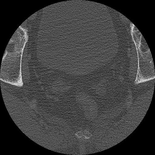 Benign post-traumatic pseudopneumoperitoneum (Radiopaedia 71199-81495 Axial bone window 322).jpg