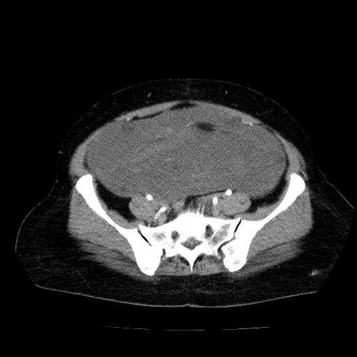 Benign spindle cell tumor - abdominopelvic (Radiopaedia 61300-69212 A 46).jpg