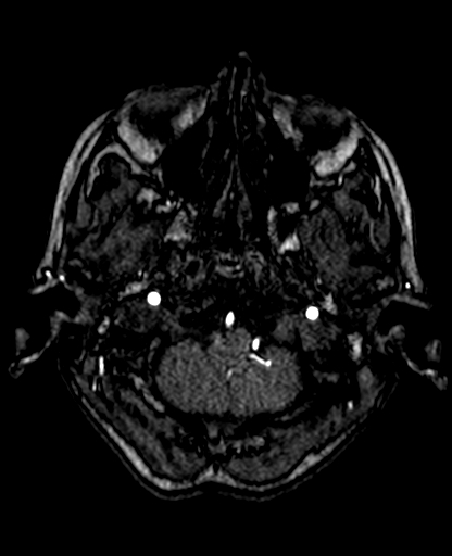 File:Berry aneurysm of the terminal internal carotid artery (Radiopaedia 88286-104918 Axial TOF 53).jpg