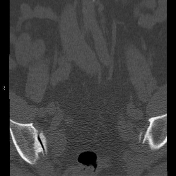 Bertolotti syndrome (Radiopaedia 24864-25128 Coronal bone window 4).jpg